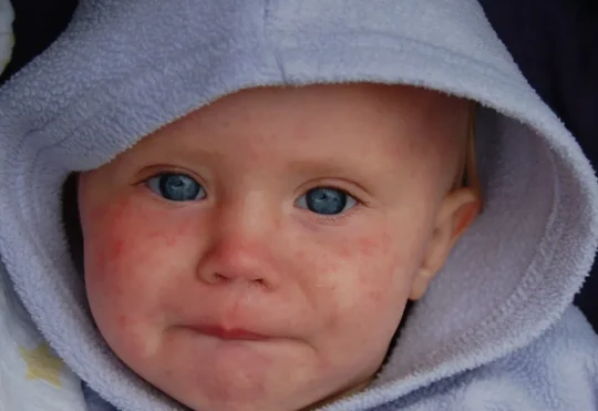 Nova Scotia measles outbreak grows to 30 cases, mostly among unvaccinated youth